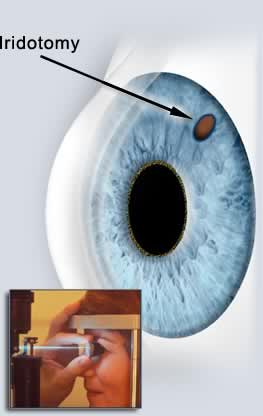 glaucoma 4.jpg